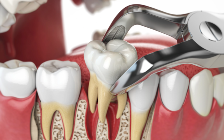 Extractions