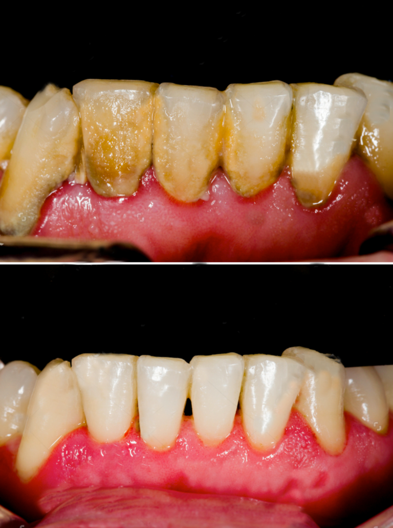 teeth cleaning